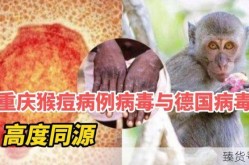重庆猴痘病例与德国病毒高度同源（猴痘病毒的临床症状）