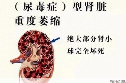 男子患肾病吃半个月桔子查出尿毒症（尿毒症吃桔子）
