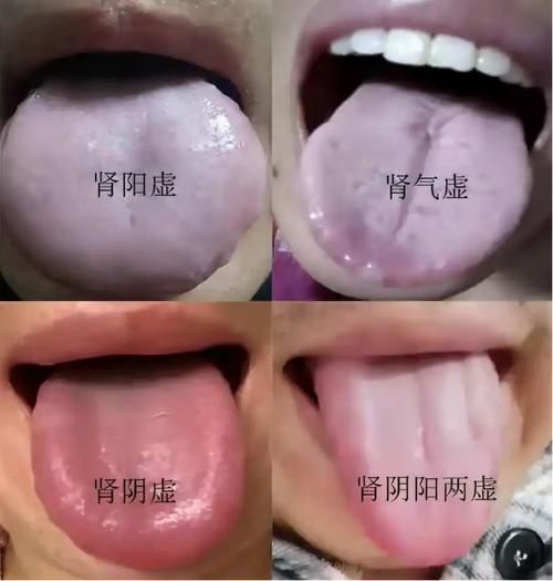 女性肾阴虚和肾阳虚的区别与症状图片分析 女人肾阳虚症状