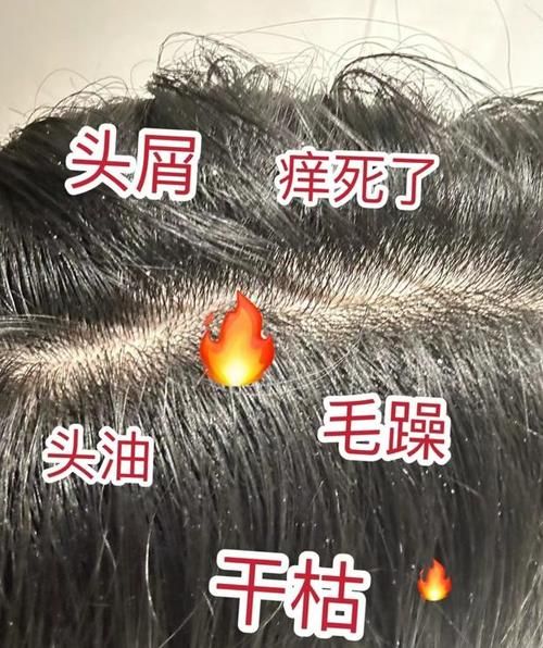 洗掉头皮屑的方法 怎么去掉头皮屑最有效