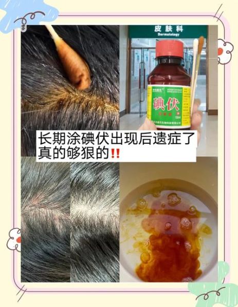 最新治疗头部脂溢性皮炎的方法 脂溢性头皮可以自愈吗