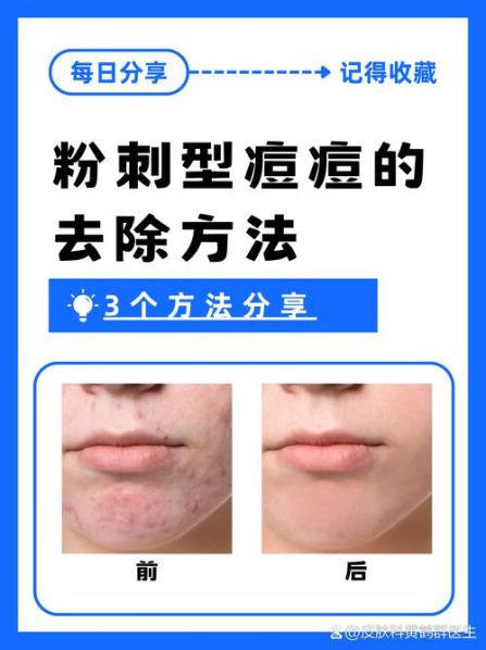 去豆豆的方法 去除痘痘的方法
