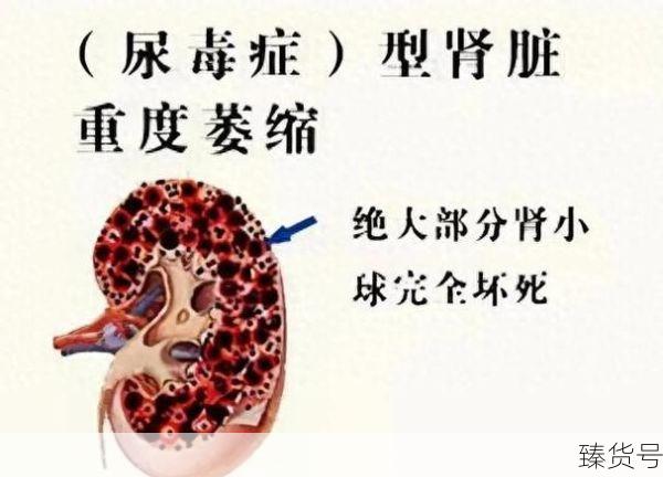 男子患肾病吃半个月桔子查出尿毒症(尿毒症吃桔子)